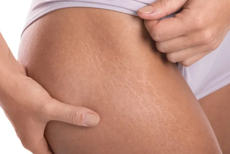 Service photo showing stretch marks on the upper thigh